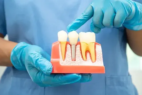 What is the Cost of Dental Implants in Mumbai?